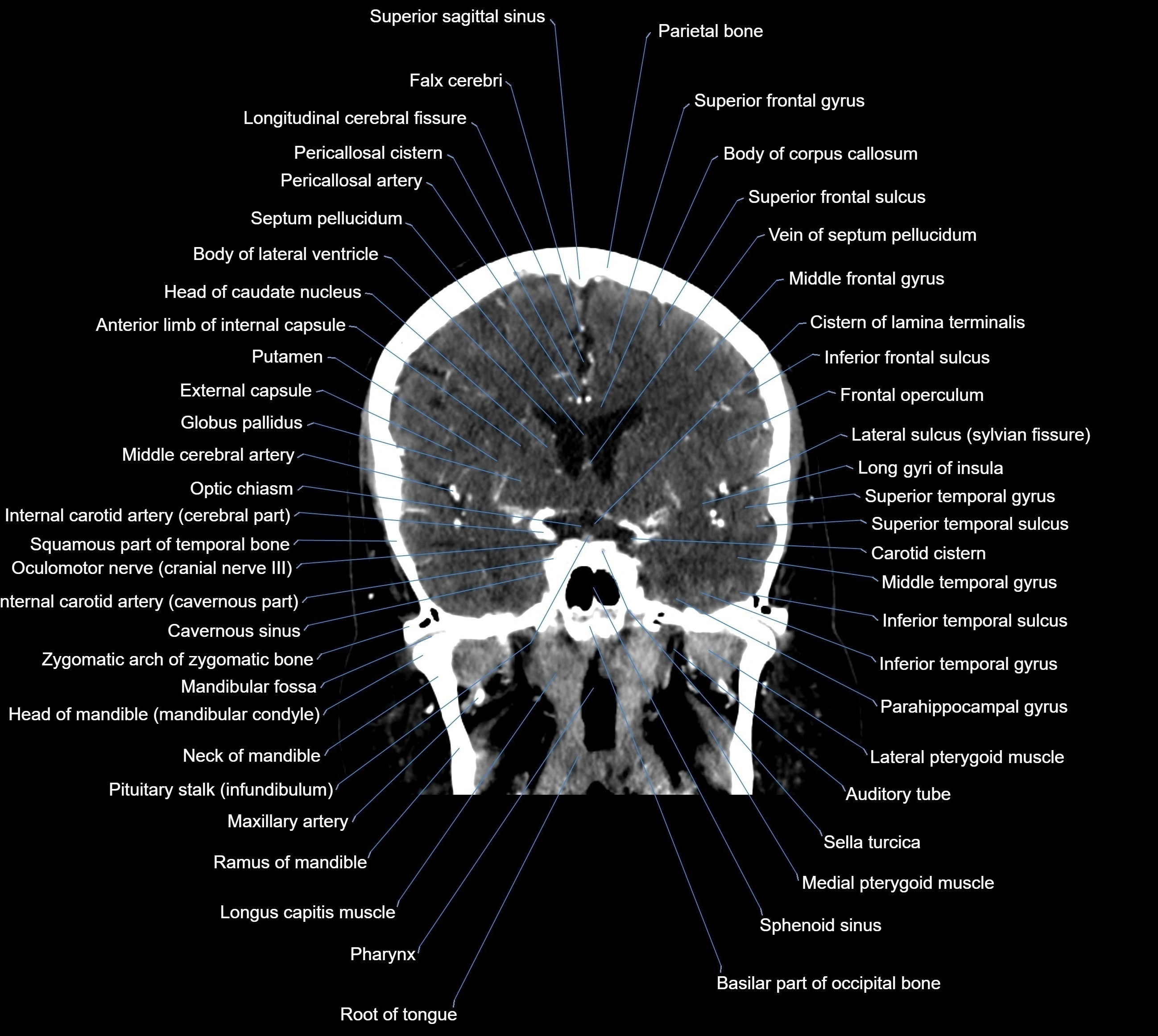 CT Brain coronal cross sectional radiology anatomy image  -img-00001-021.webp